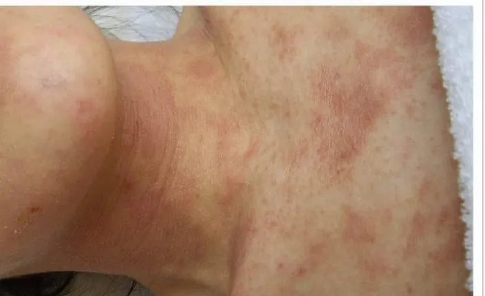 紅斑明顯減退，融合的大片紅轉為散在的紅色斑疹