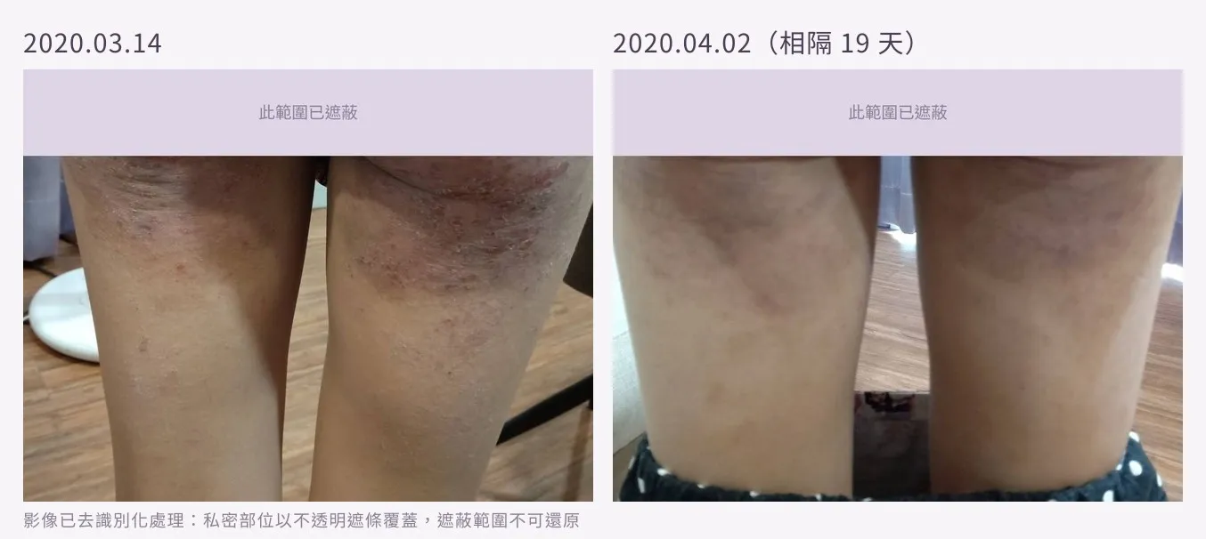 大腿後側皮膚治療前後對照：左為病灶活動期，皮膚粗糙、色澤暗紅並有明顯抓痕與丘疹；右為相隔十九天後，表面平整，僅餘色素沉著
